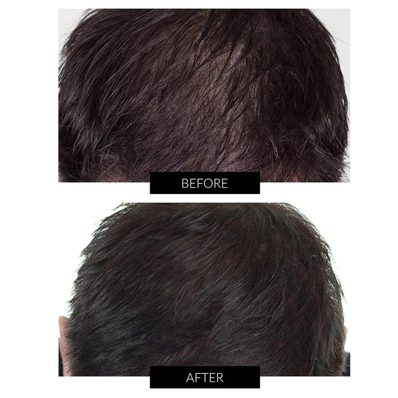 CAPILLUSX+ (244 DIODE) HAIR REGROWTH LASER CAP